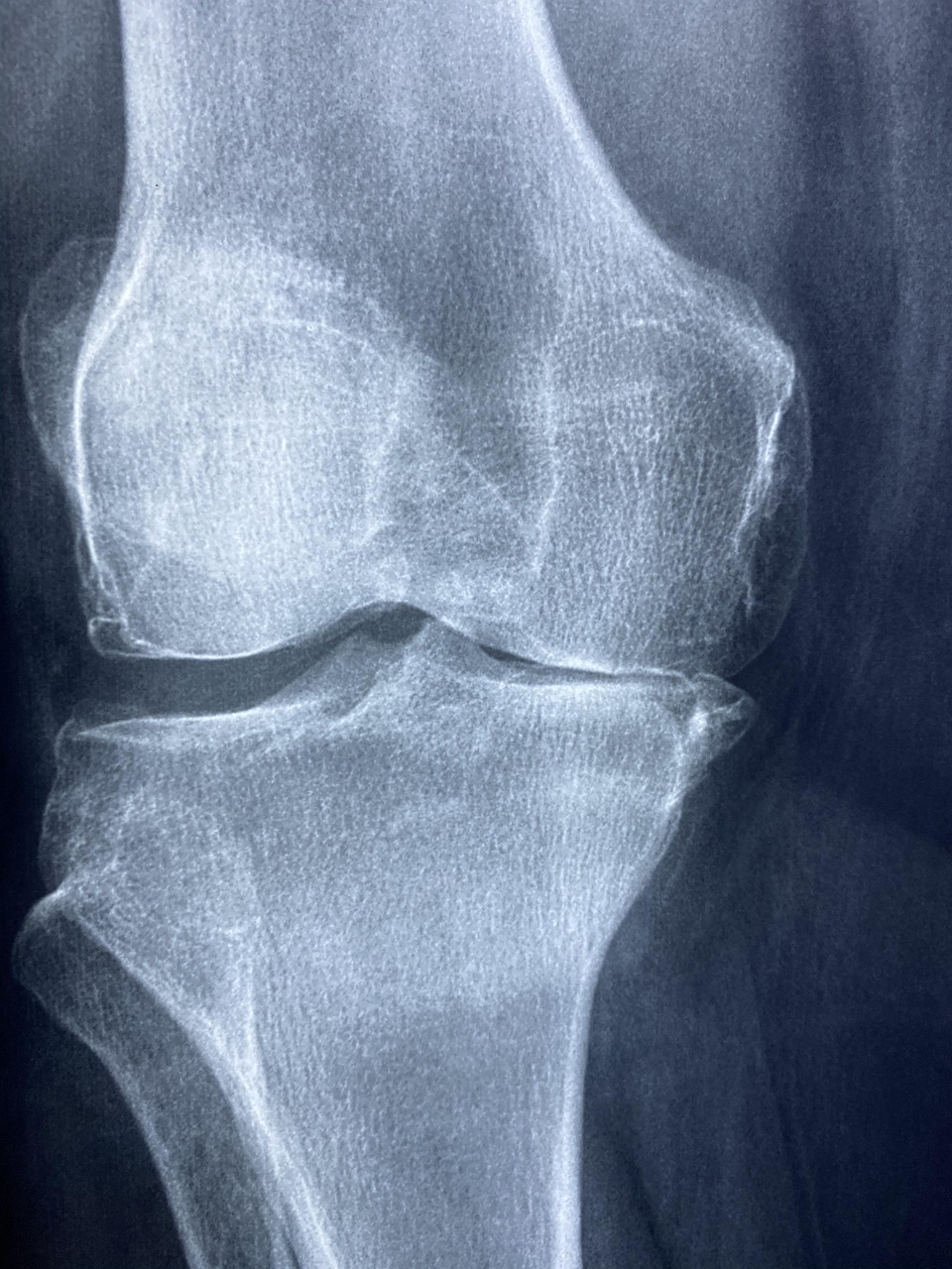 arthritis ist eine entzündliche erkrankung der gelenke, die schmerzen, schwellungen und bewegungseinschränkungen verursacht. erfahren sie mehr über symptome, ursachen, behandlungsmöglichkeiten und vorbeugung von arthritis.
